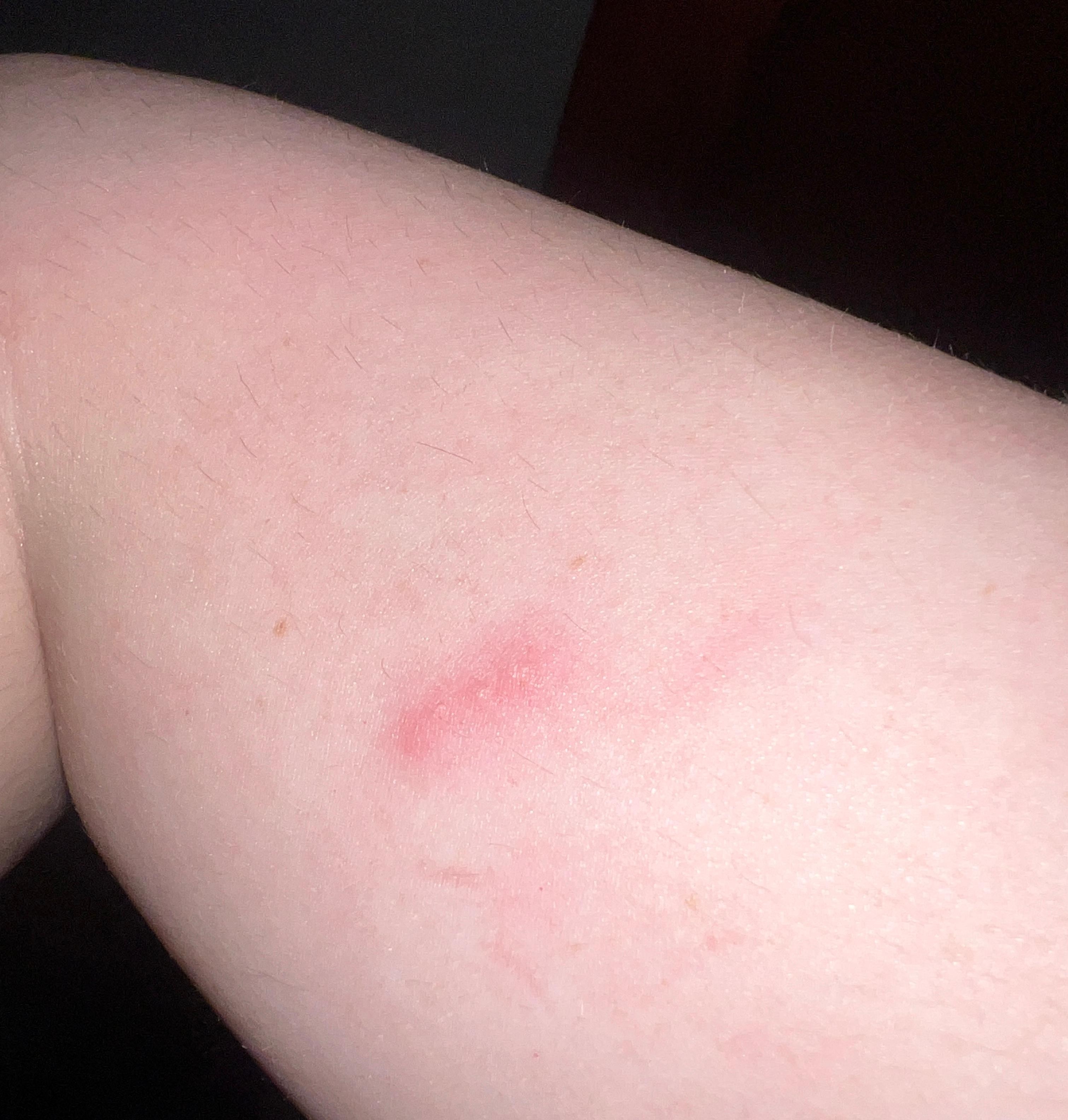 A cluster of four bites on my arm.
