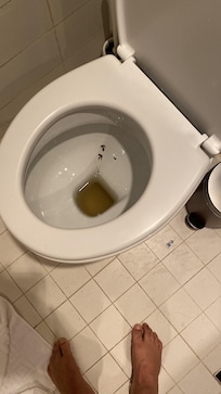 Unhealthy toilet bowl
