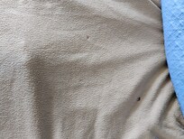 Burns in the sheets