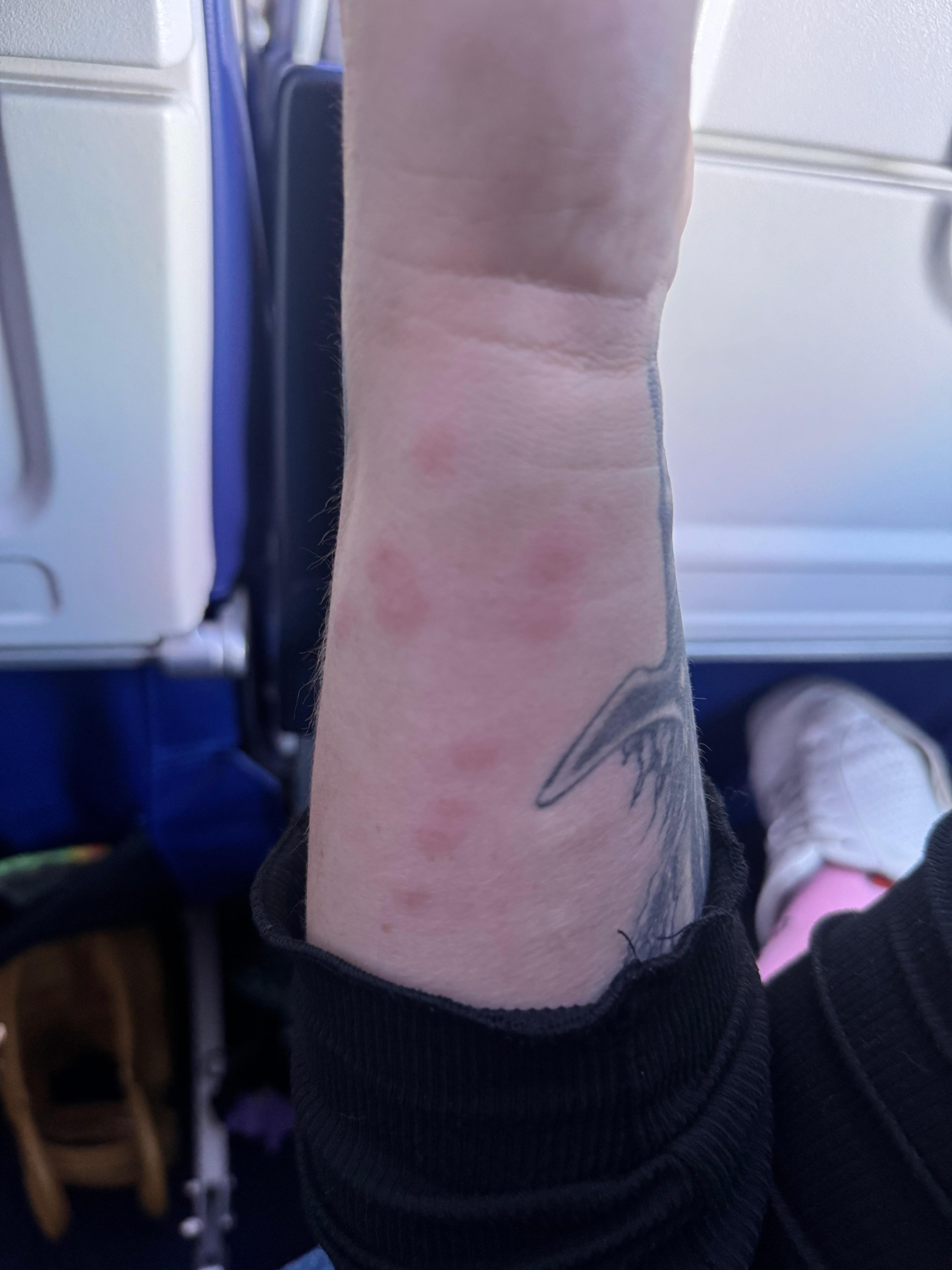 bed bug bites everywhere