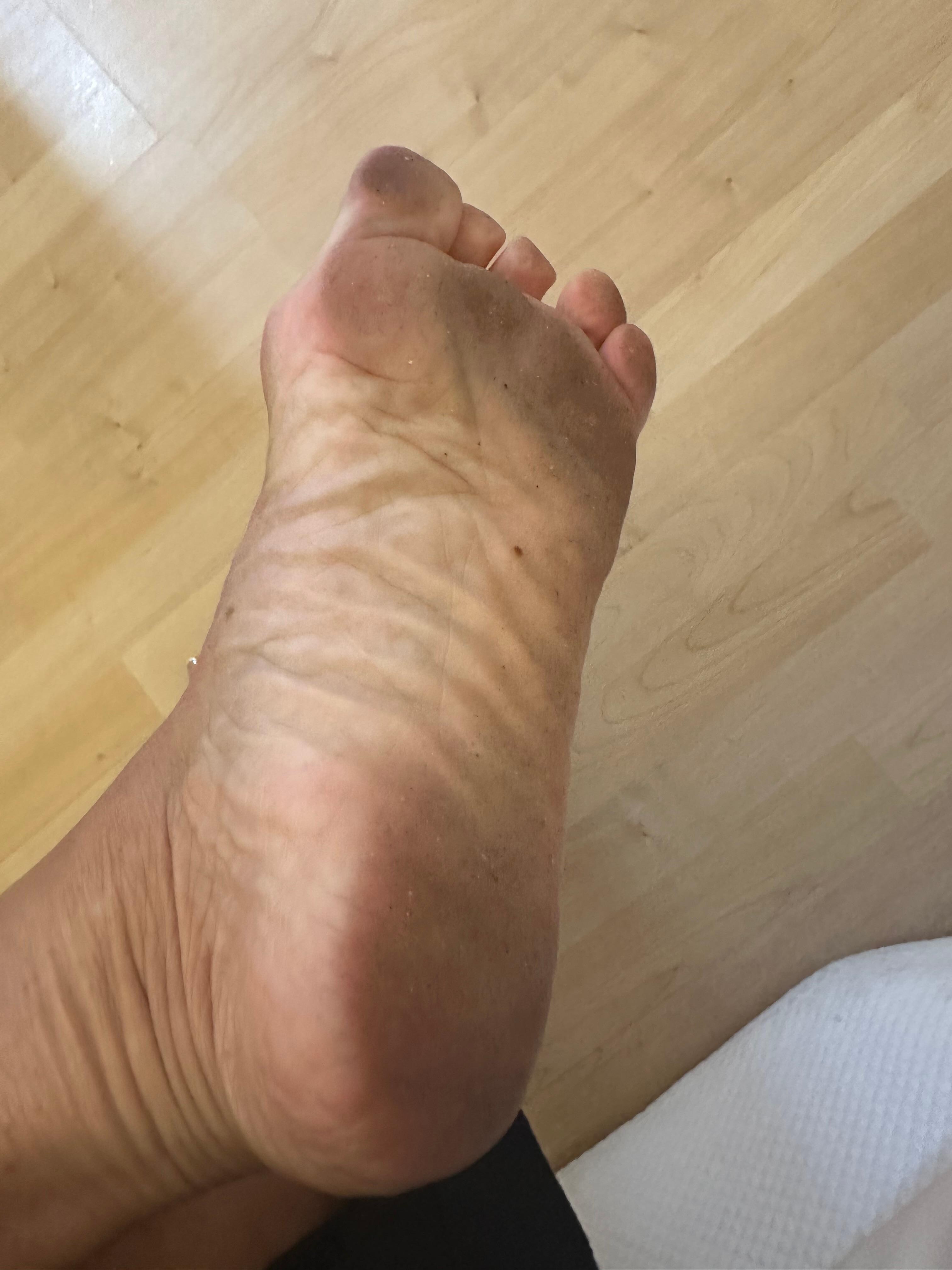 My feet after showering and walking around the room. Had to wash them again Nd immediately pit my shoes on 