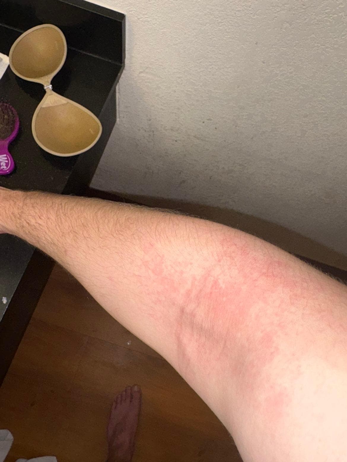 Rashes from water