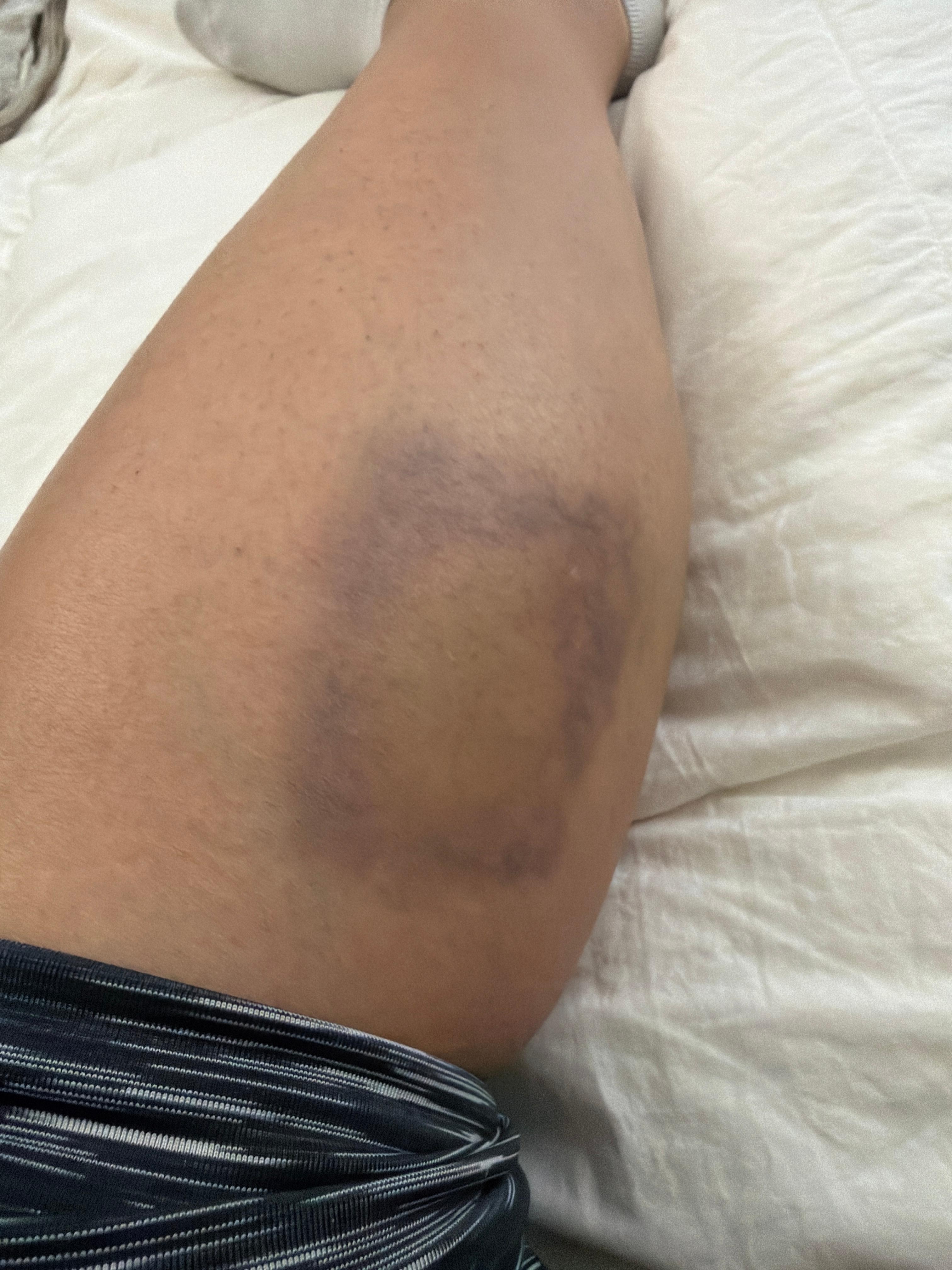 Mattress slid off frame, leg slid down frame. Ouch