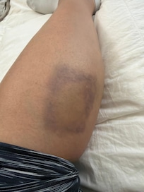 Mattress slid off frame, leg slid down frame. Ouch