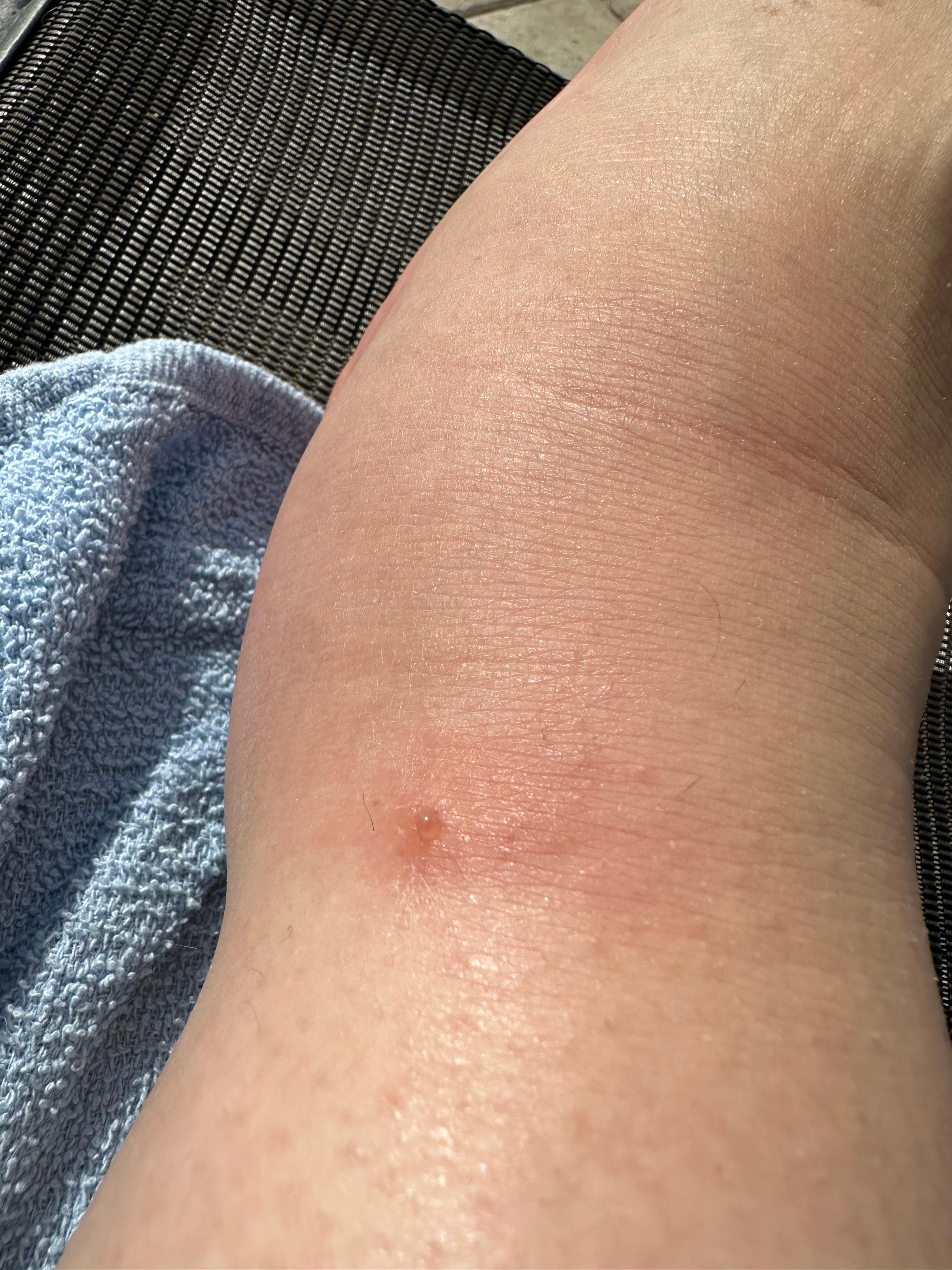 My ankle that swelled up from the bite, this is the next day!!