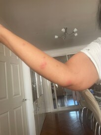 Bed bugs bites