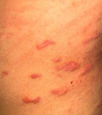Dermatologist confirmed scabies.