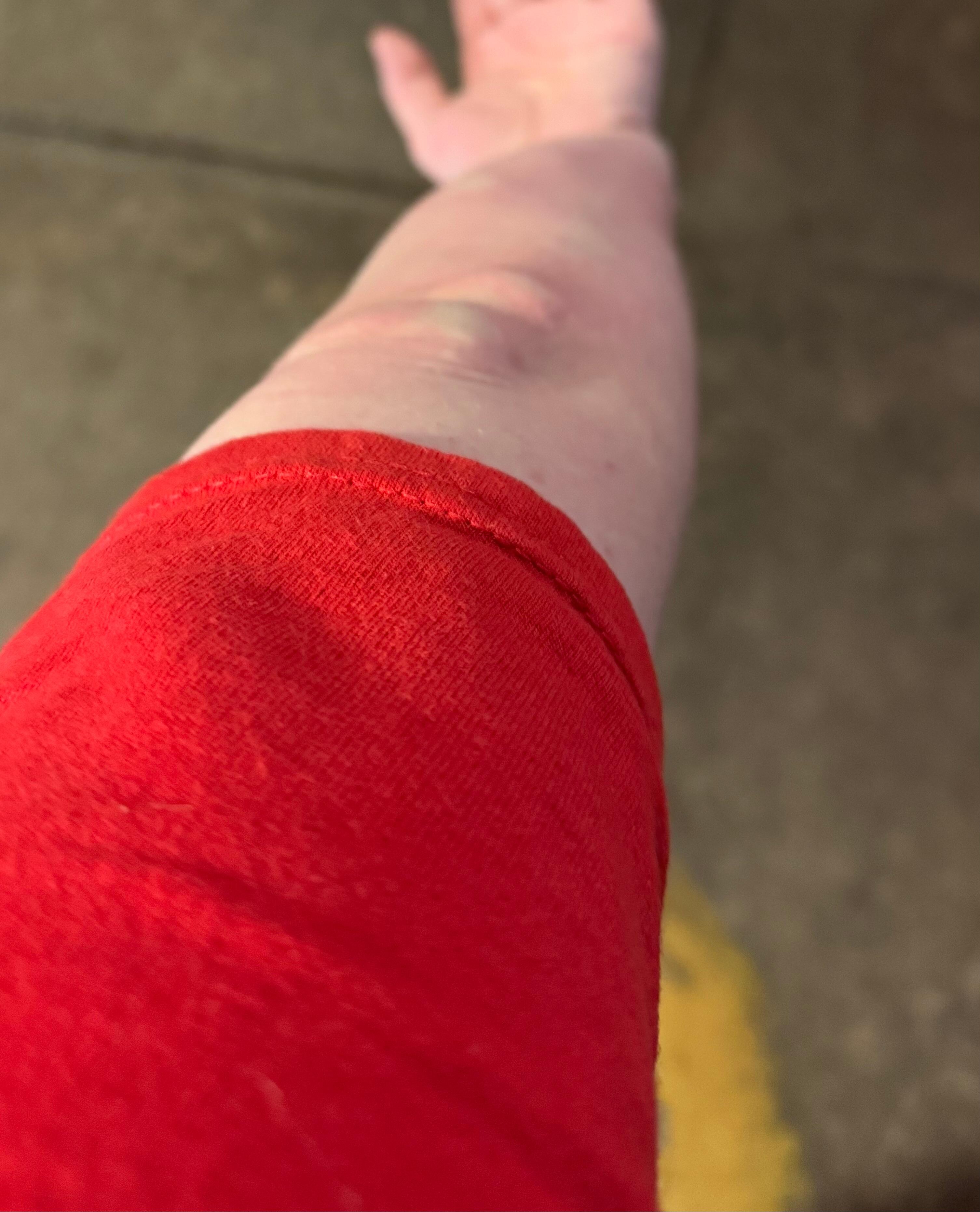 Arm bites