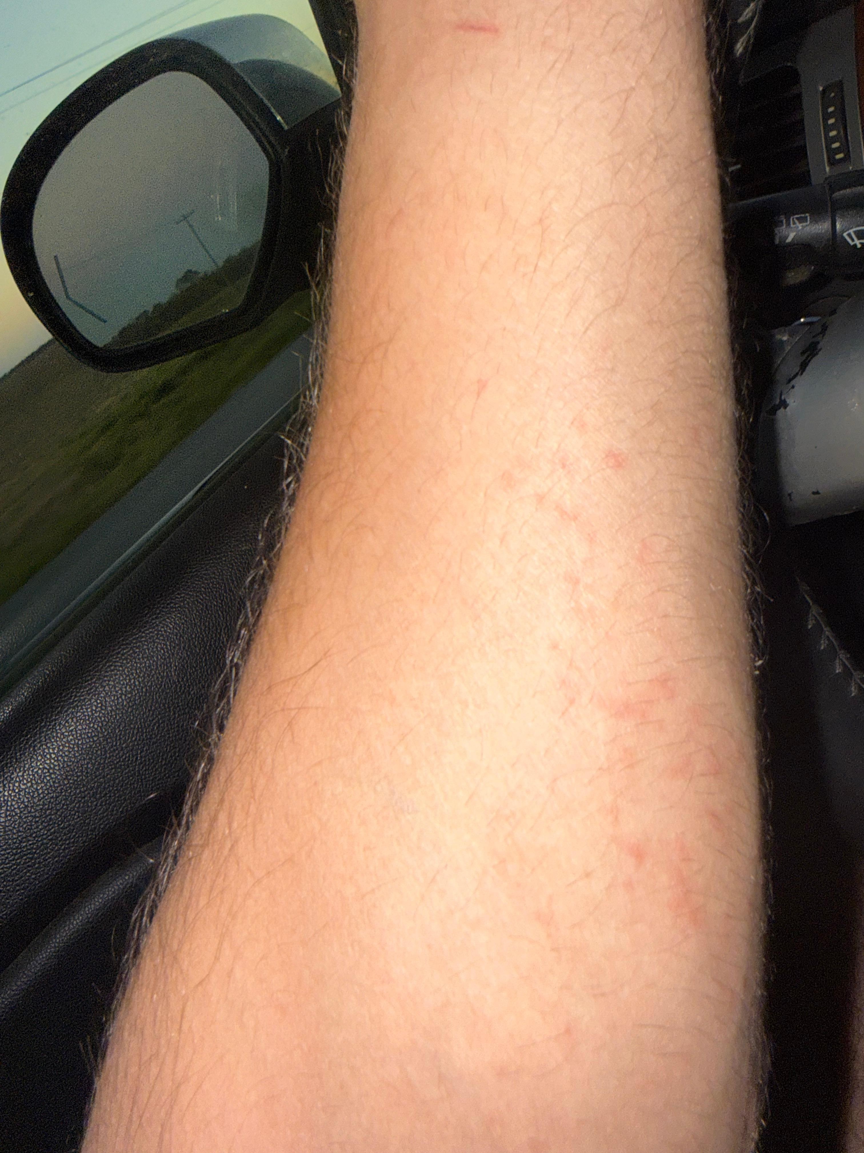 Covered in bed bug bites.