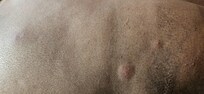 Bedbugs bite