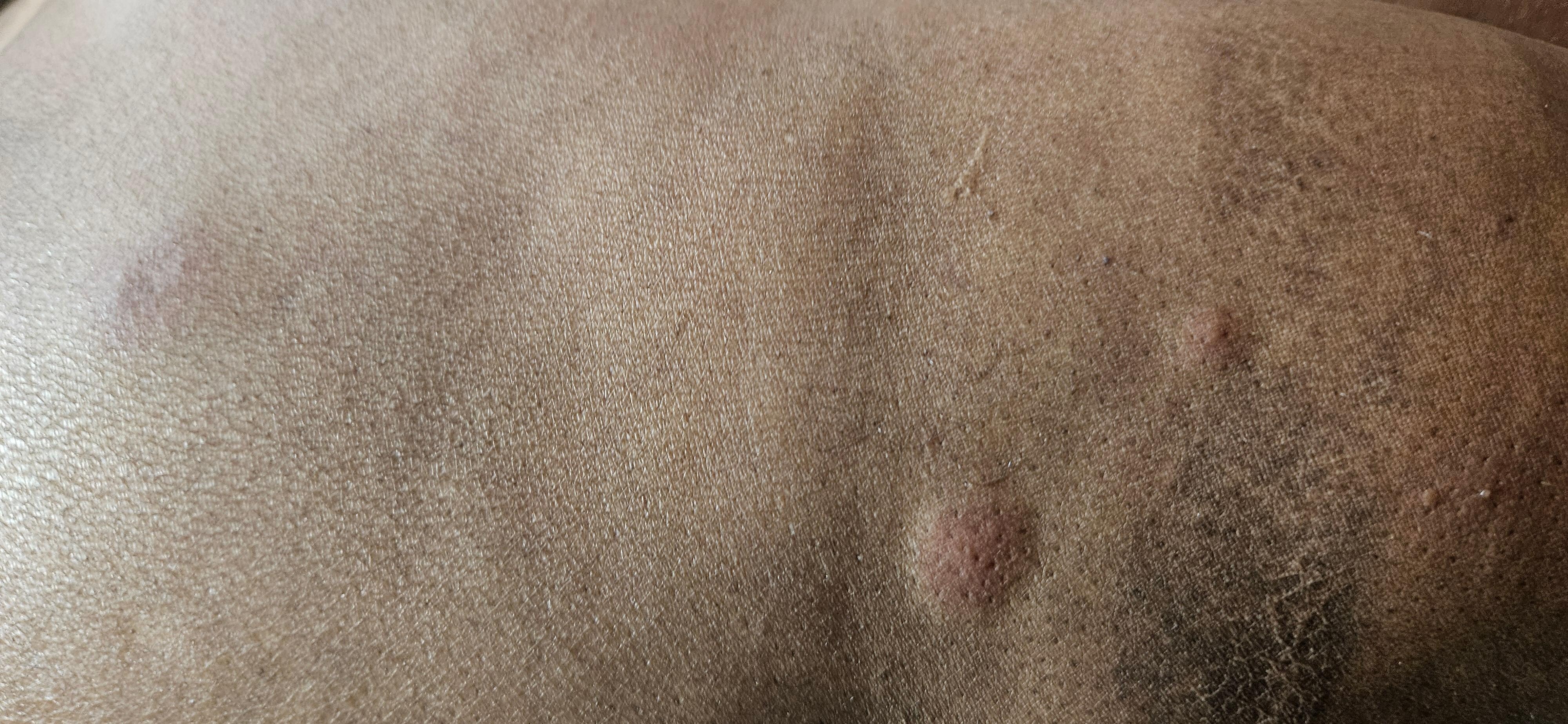 Bedbugs bite