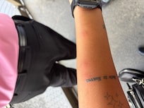Bed Bug bite in lower left arm