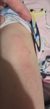 Potential bed bug bites.