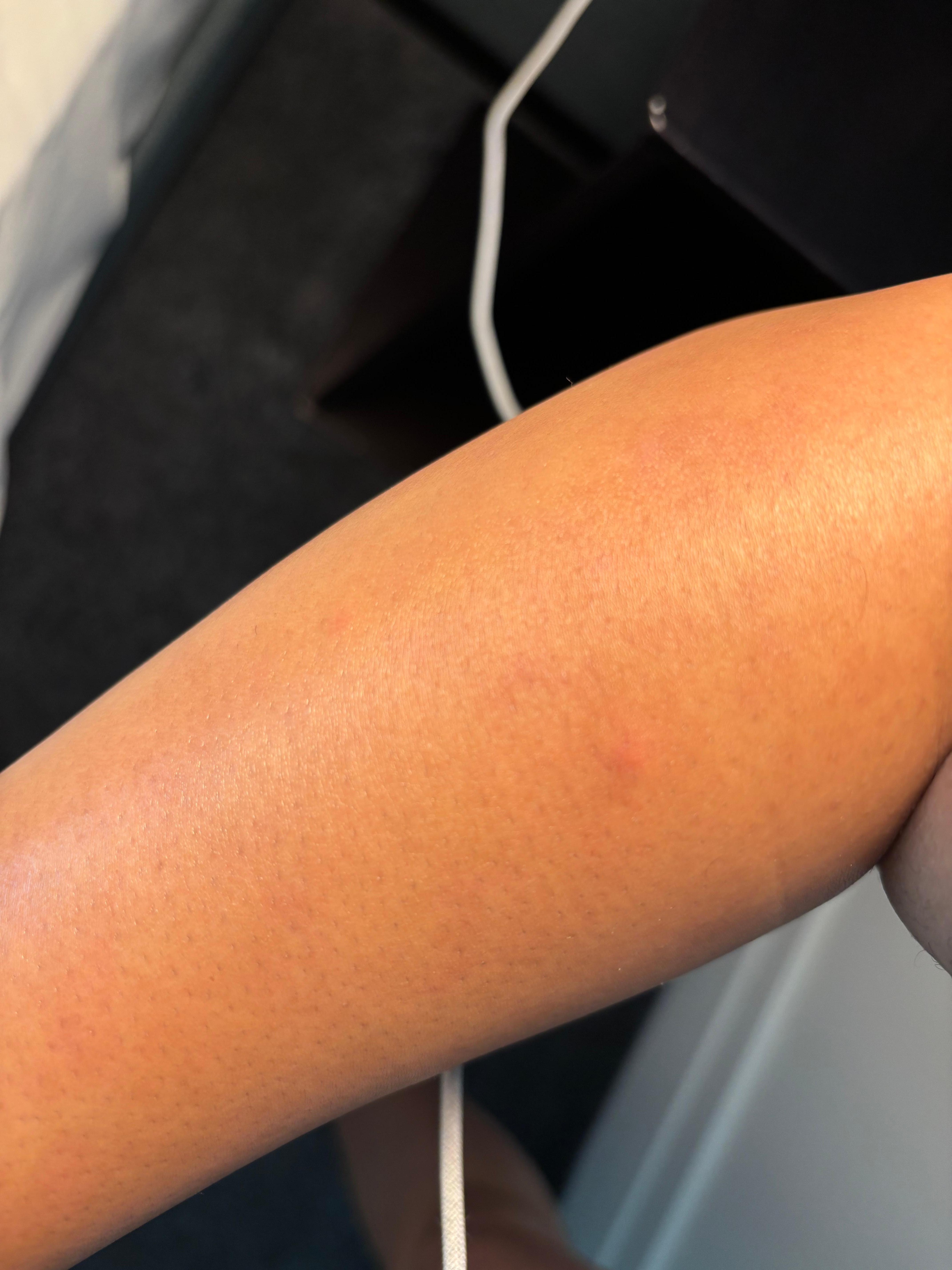 Bite marks the next morning 