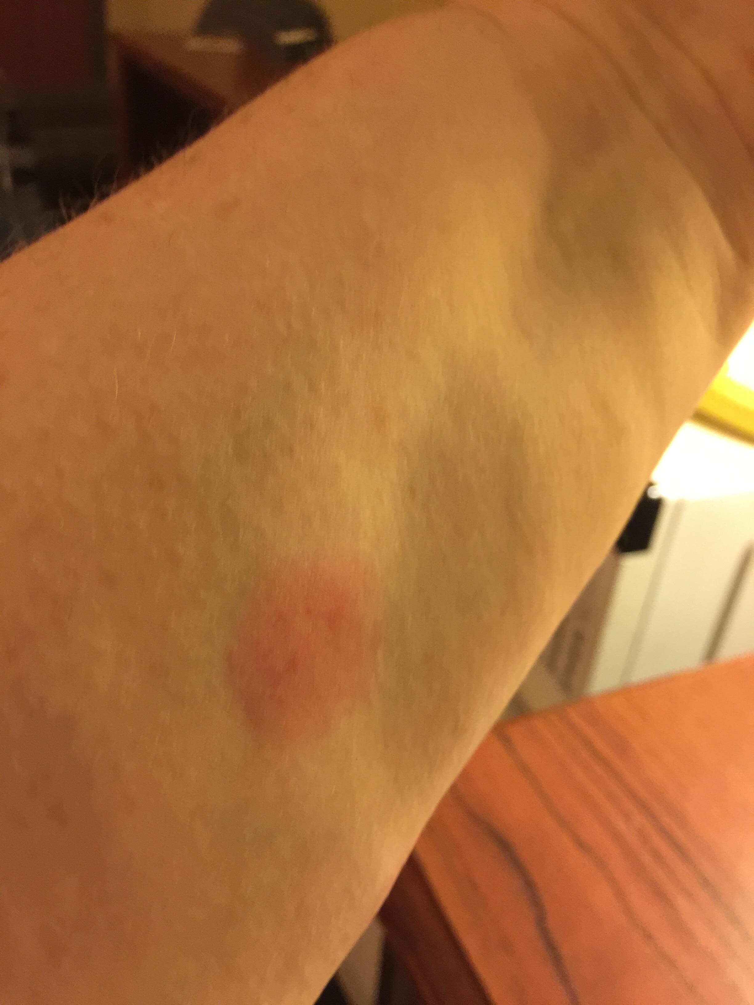 Only showing arms