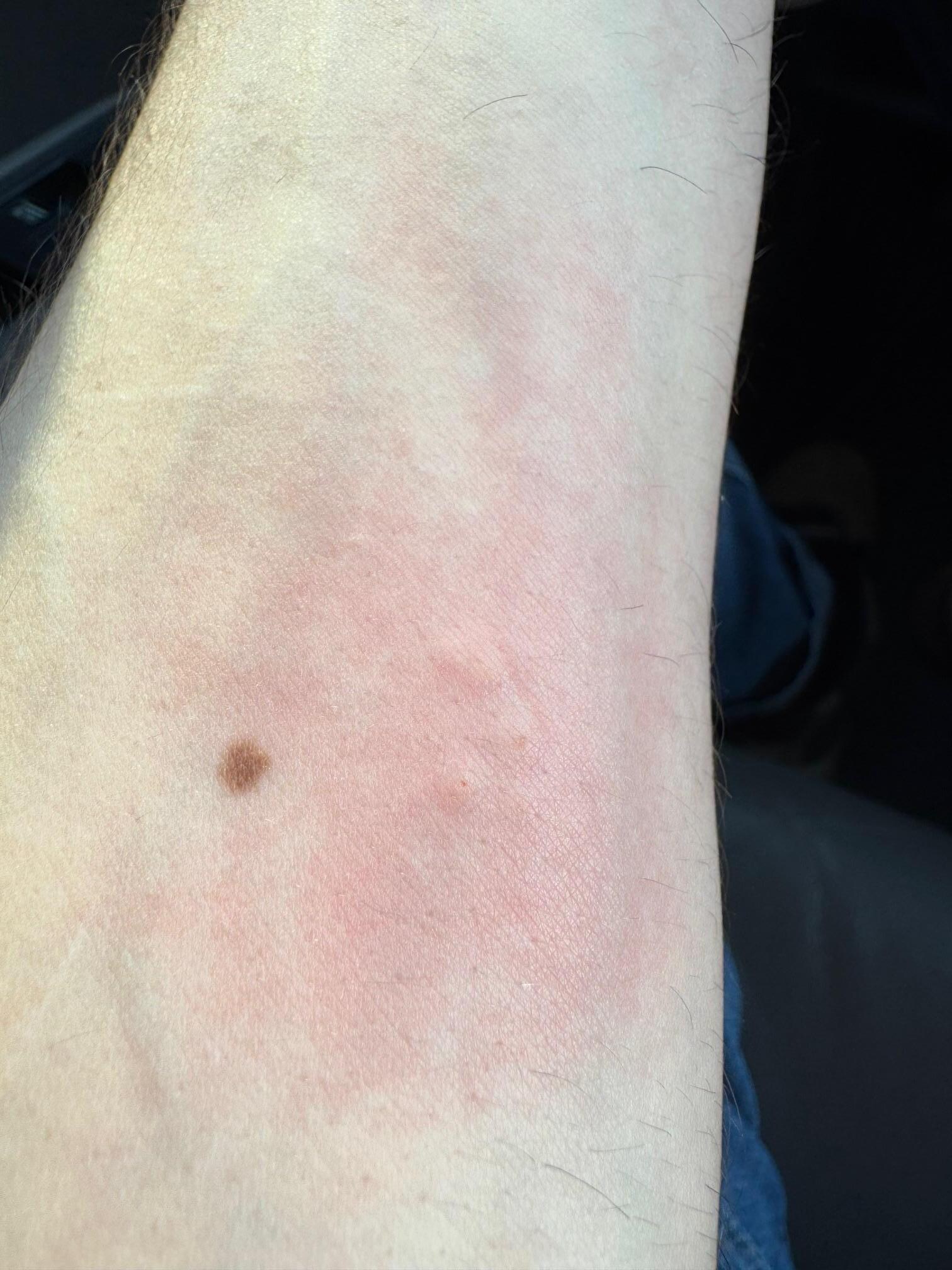 Bites