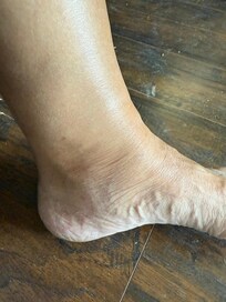 Sprained ankle