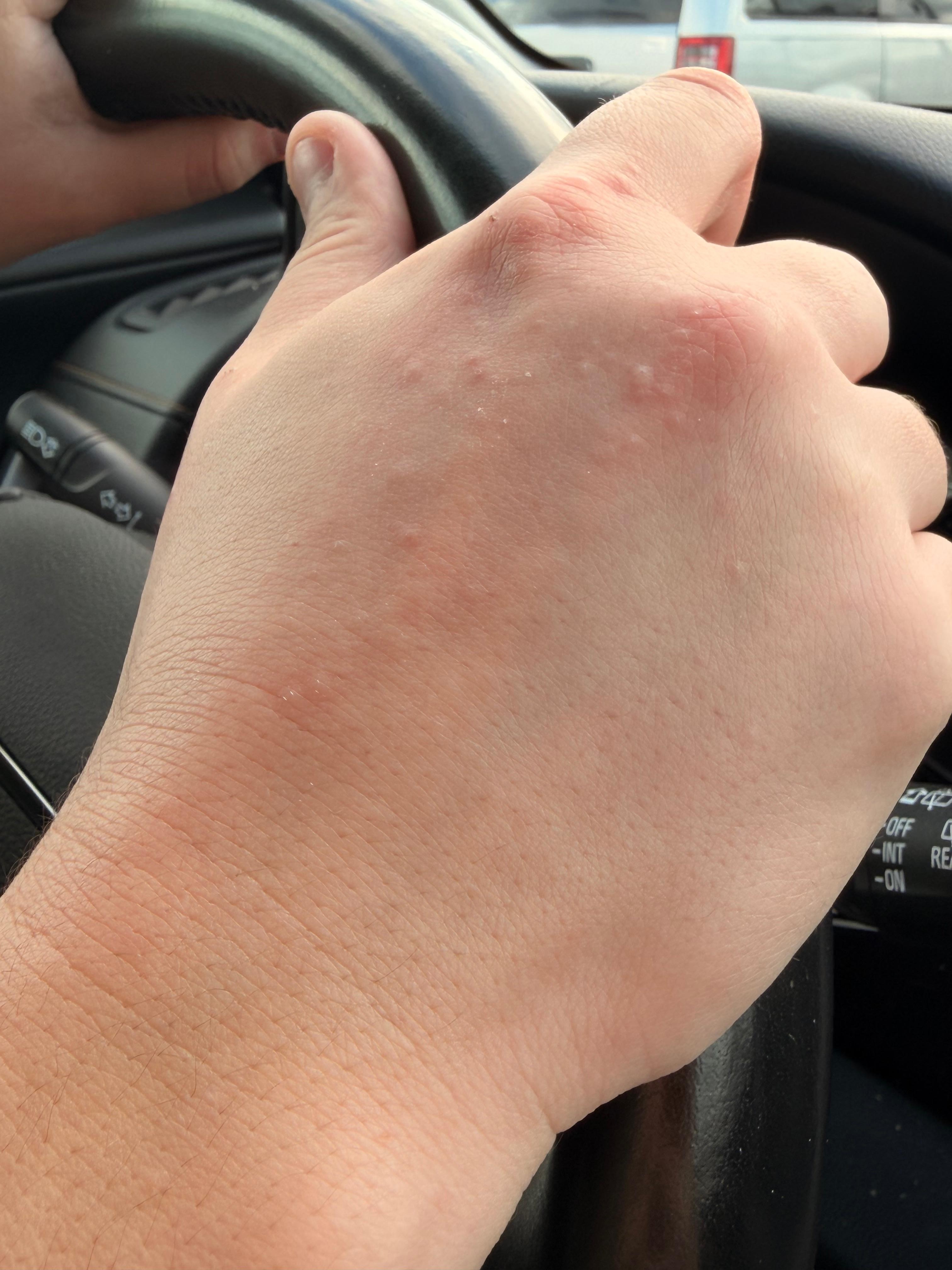 My wife’s hand full of hives from her allergy to the dogs. She broke out during our breakfast at the hotel.