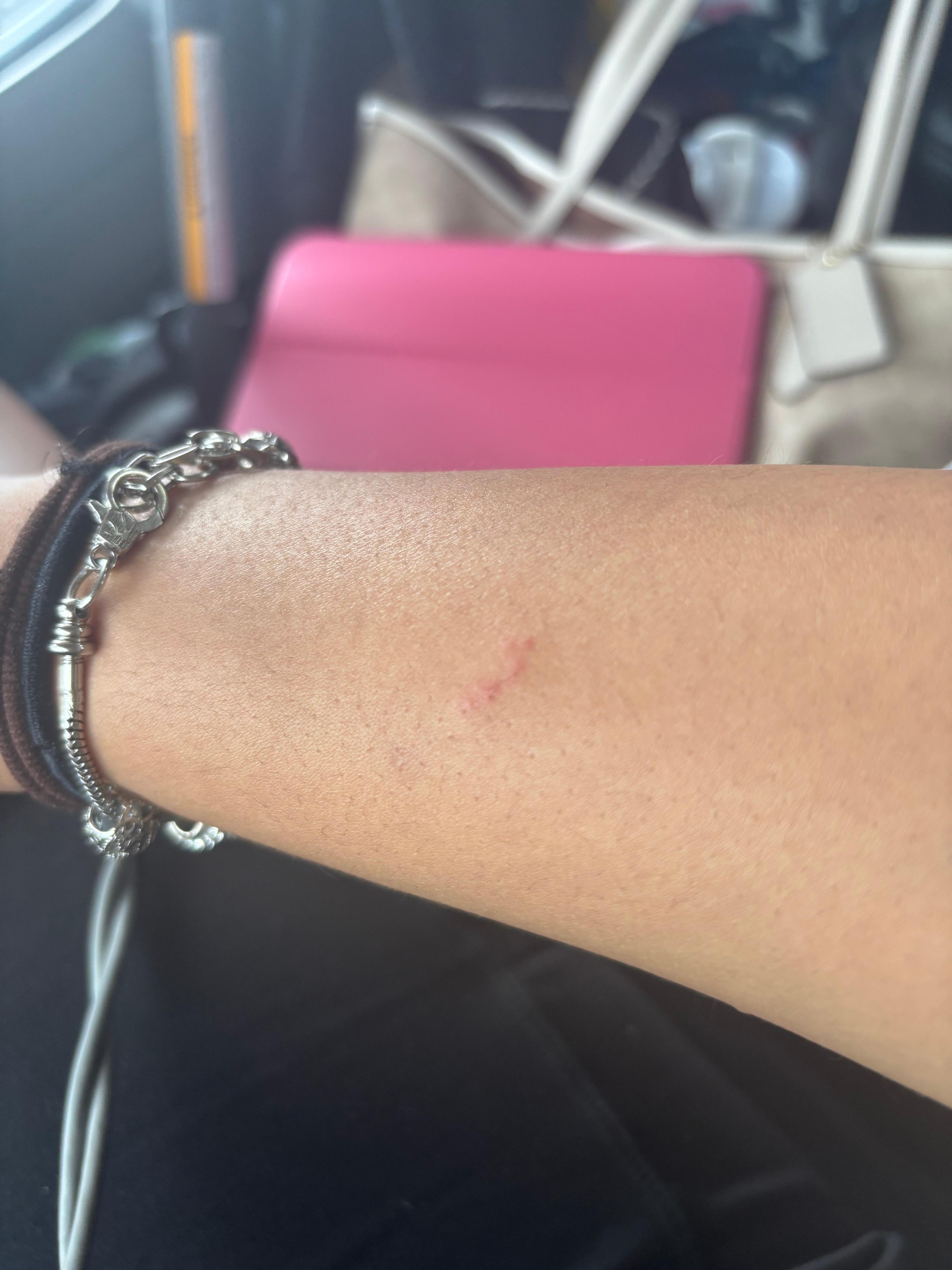 Bed bug bites arm
