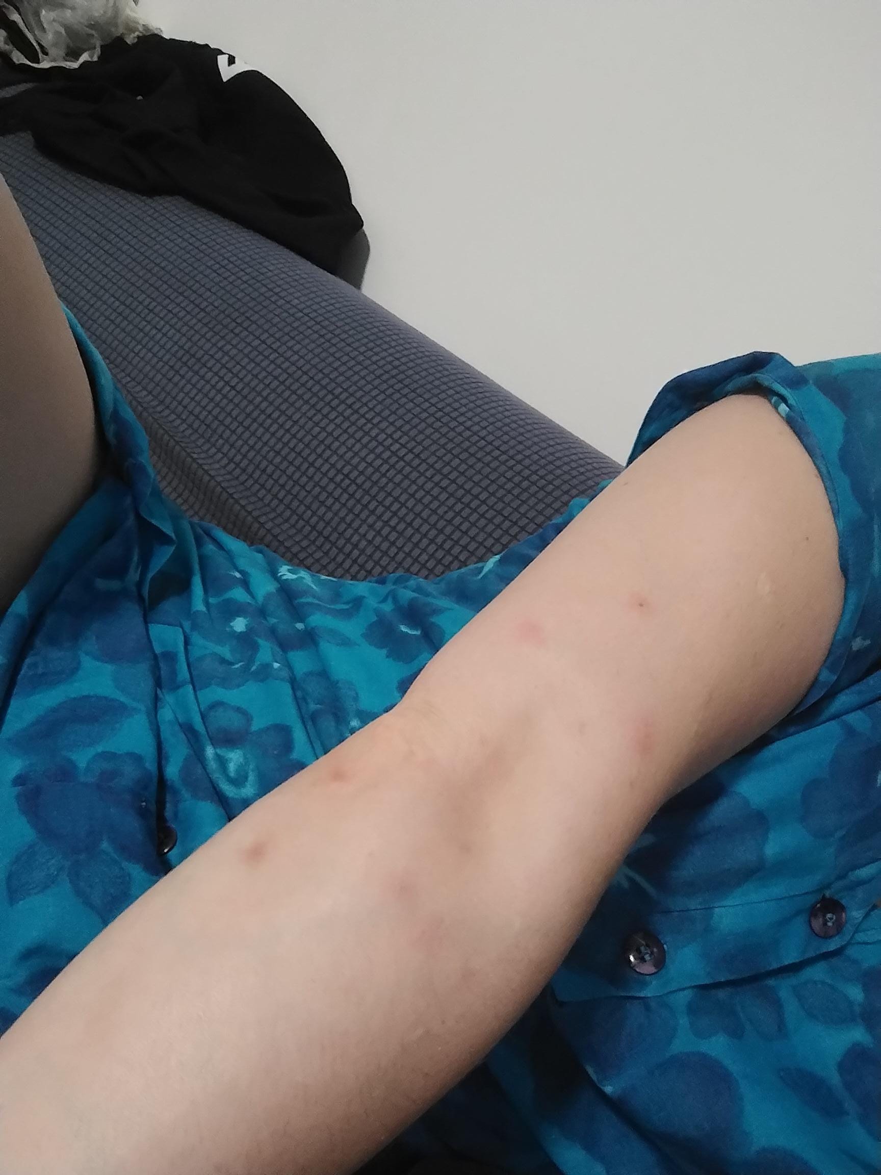Bites