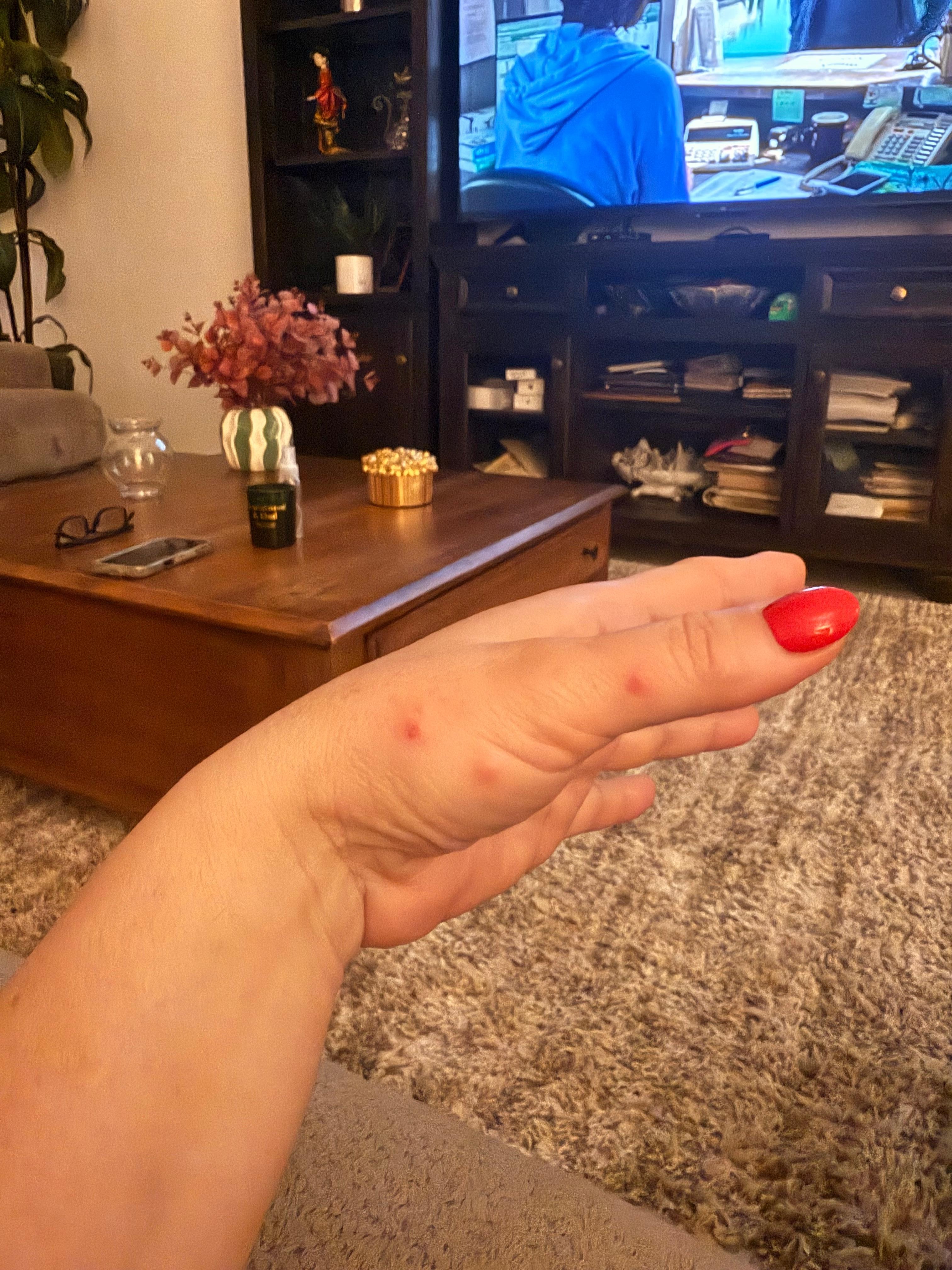 Picaduras de chinches !!