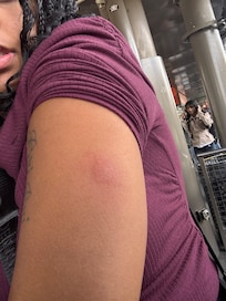 Bed Bug bite on left arm