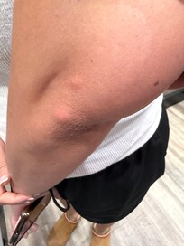 bedbug bites