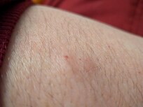 Bites I've gotten