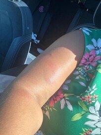 Bed bug bite