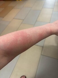 10 min in the room and I was eaten alive and severely itchy !