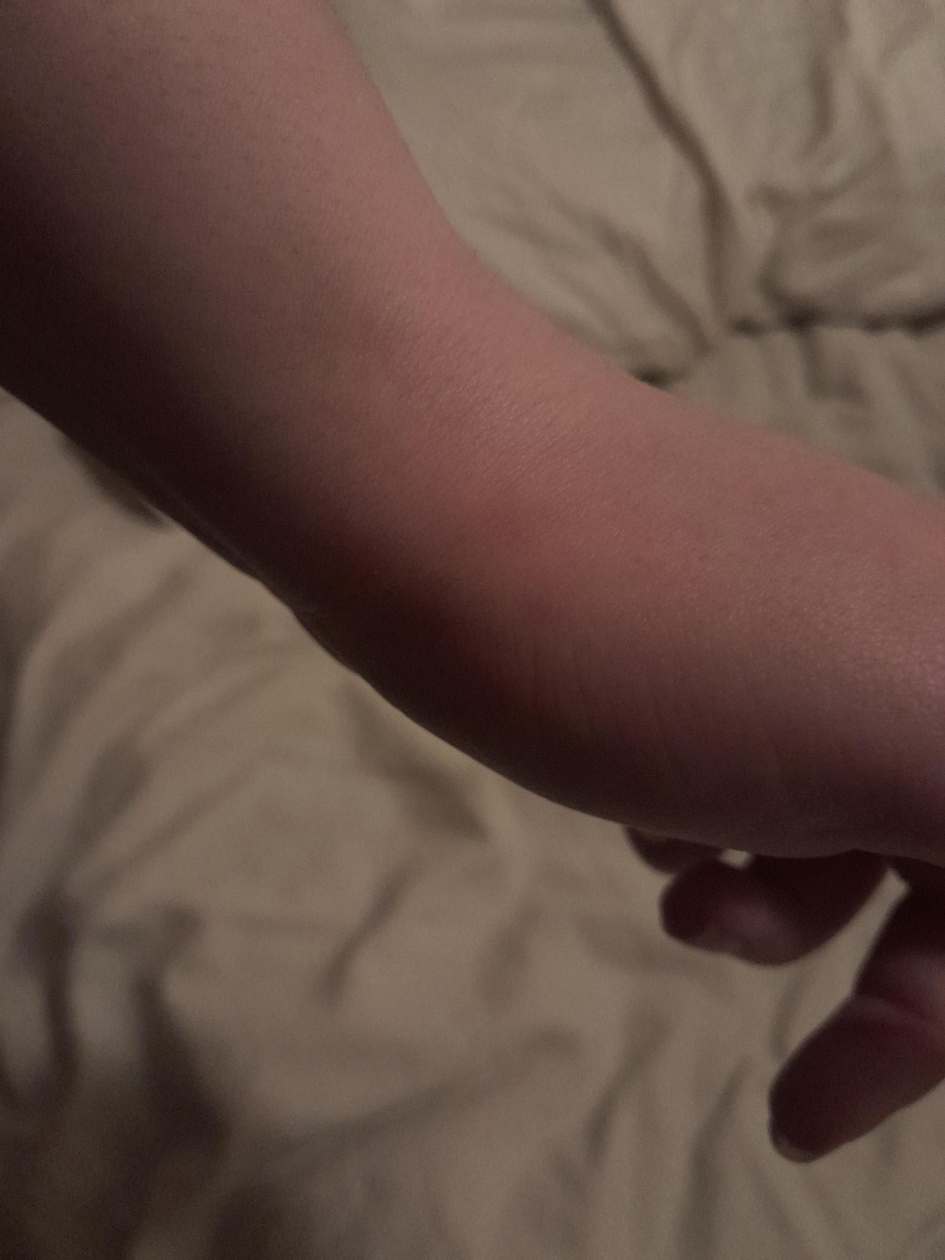 Bedbug bites from the sofa sleeper 