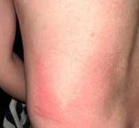 Rash caused following just 15 minutes in the hot tub due to overuse of chemicals.