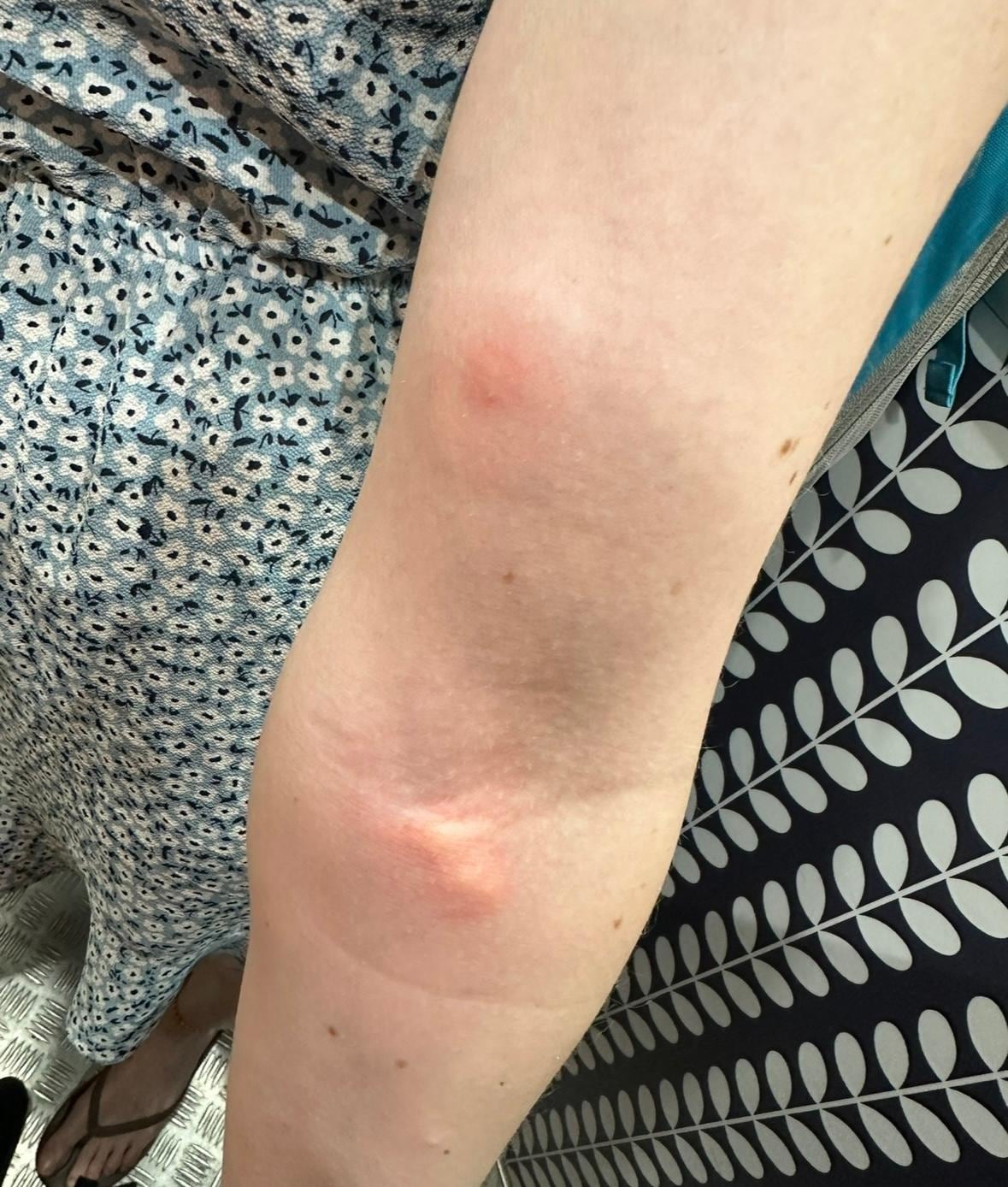 bed bug bites