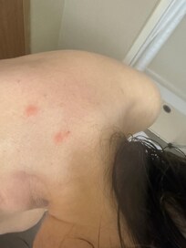 Overnite bites