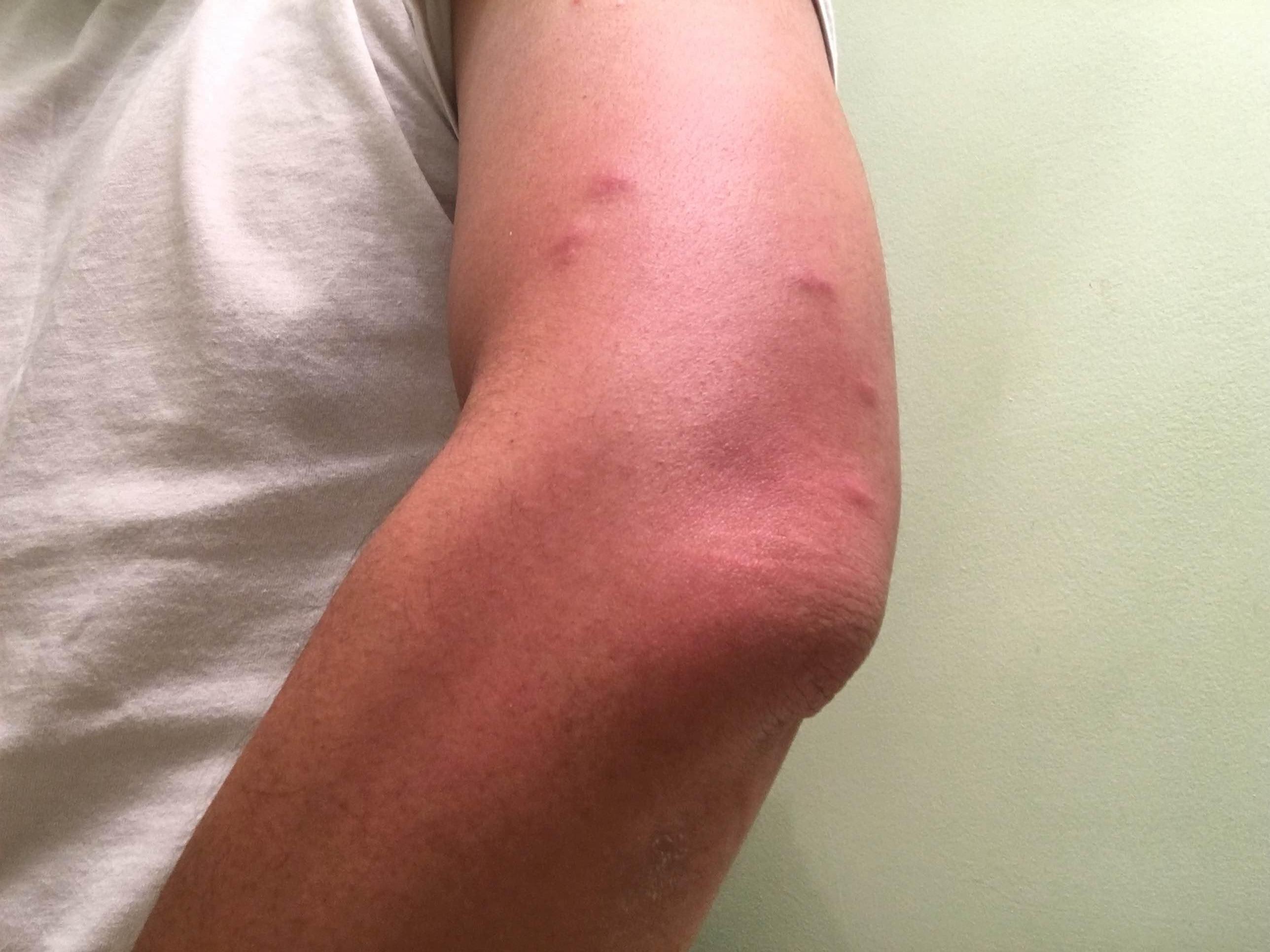 Bed bug bites of right arms