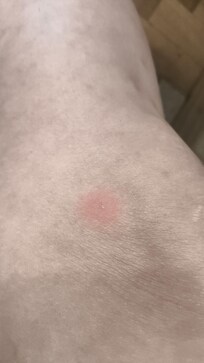 Bites