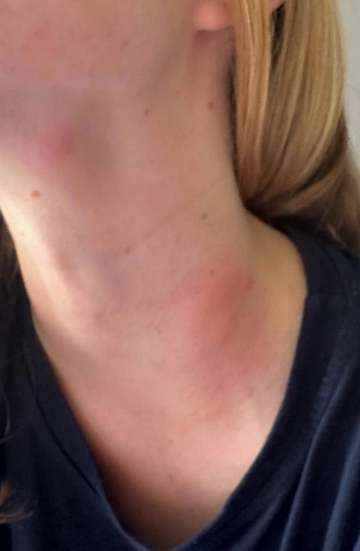 bed bug bites