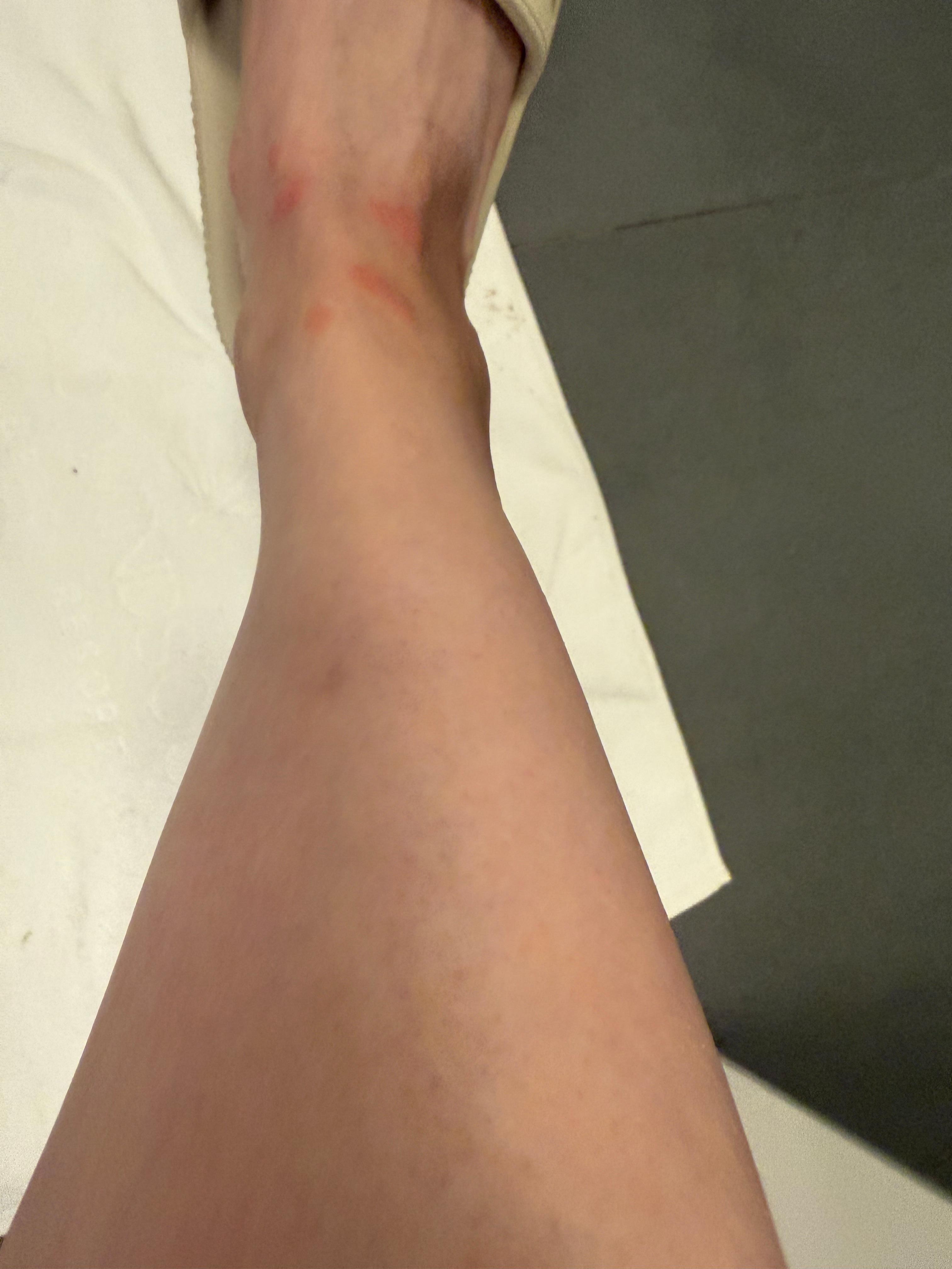 Bed bugs bites on legs