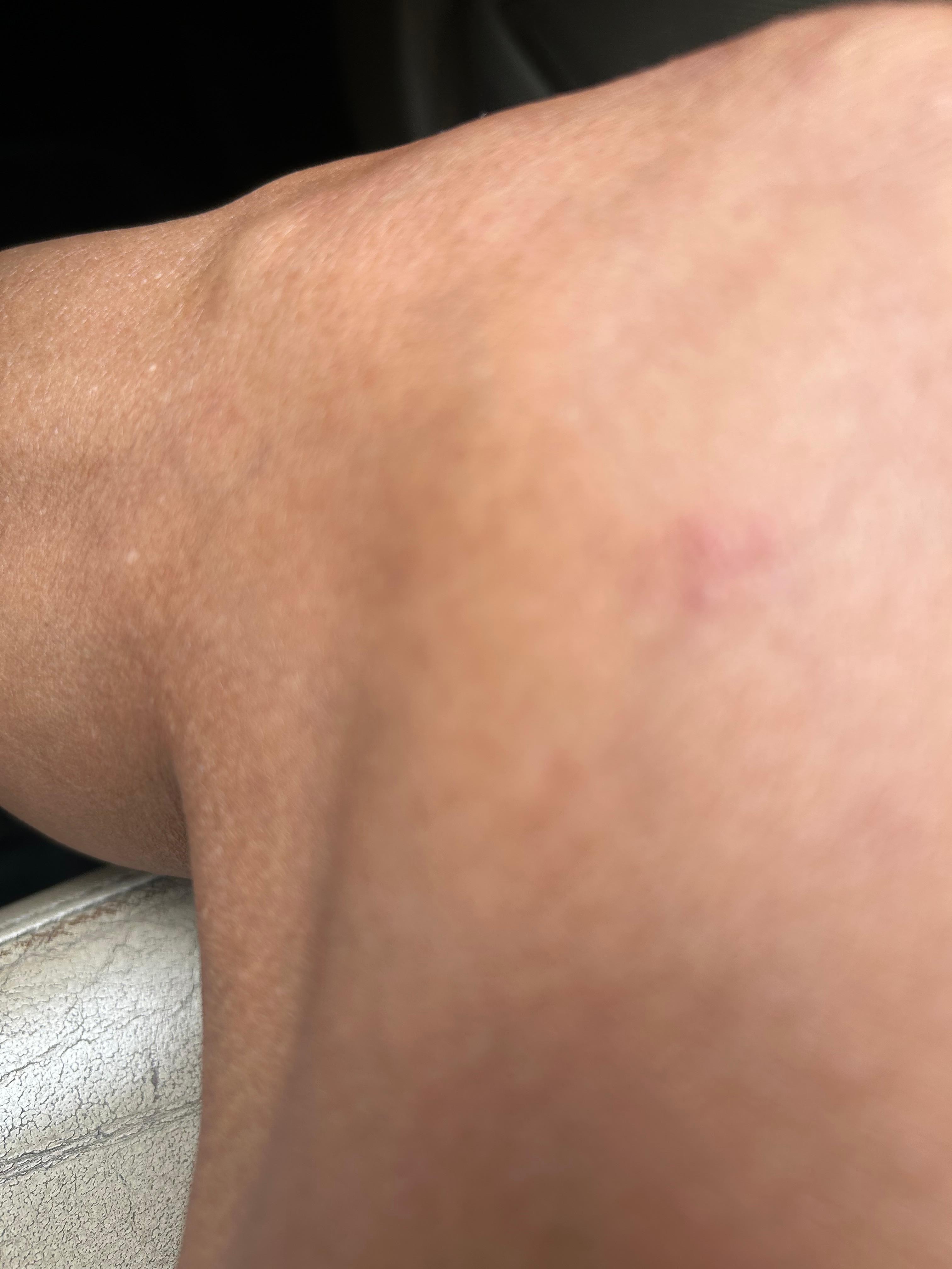 Bites