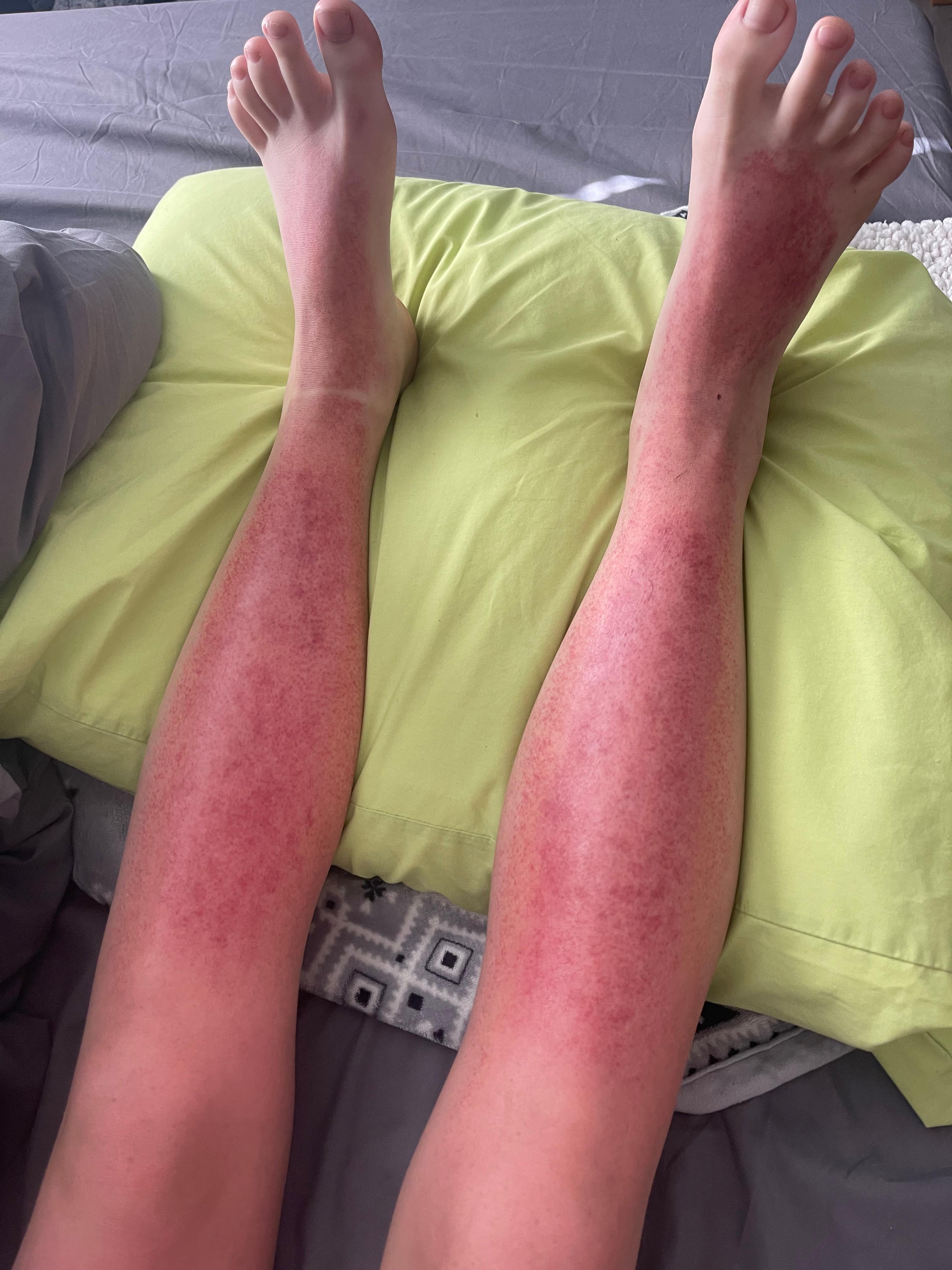 Sun poisoning 