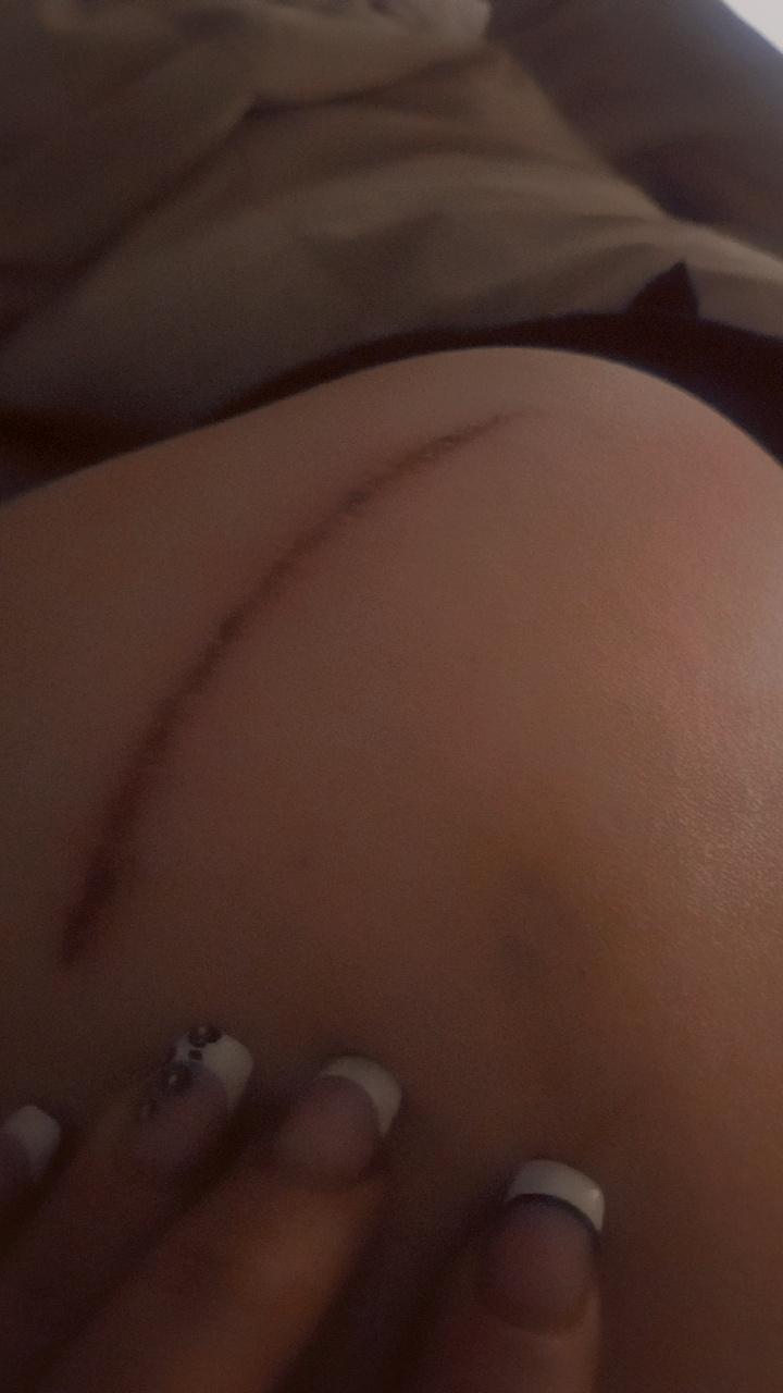 This is from having no lights in the room and the floor was slippery that caused me to fall where the bruise is. Housekeeping sucks. 