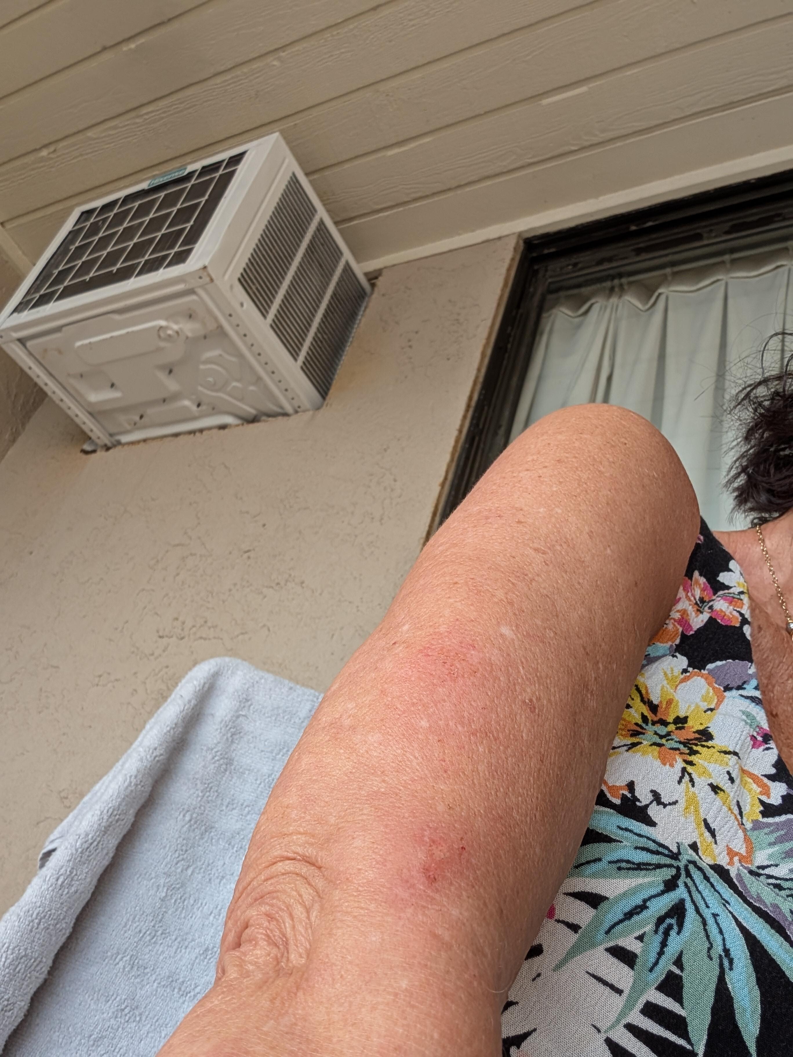 Bite rashes