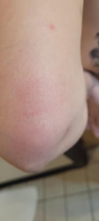 Bites