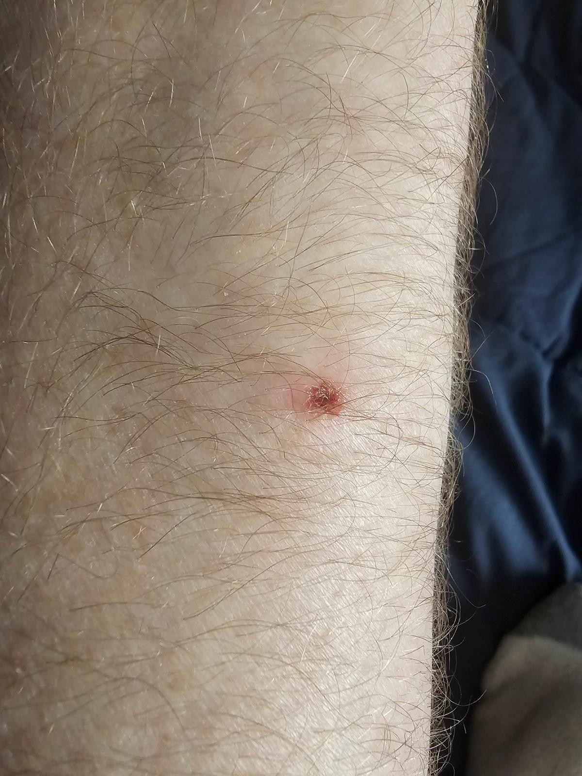 I got bit by something while I was sleeping. Caused a huge bump and an open sore on my left forearm.