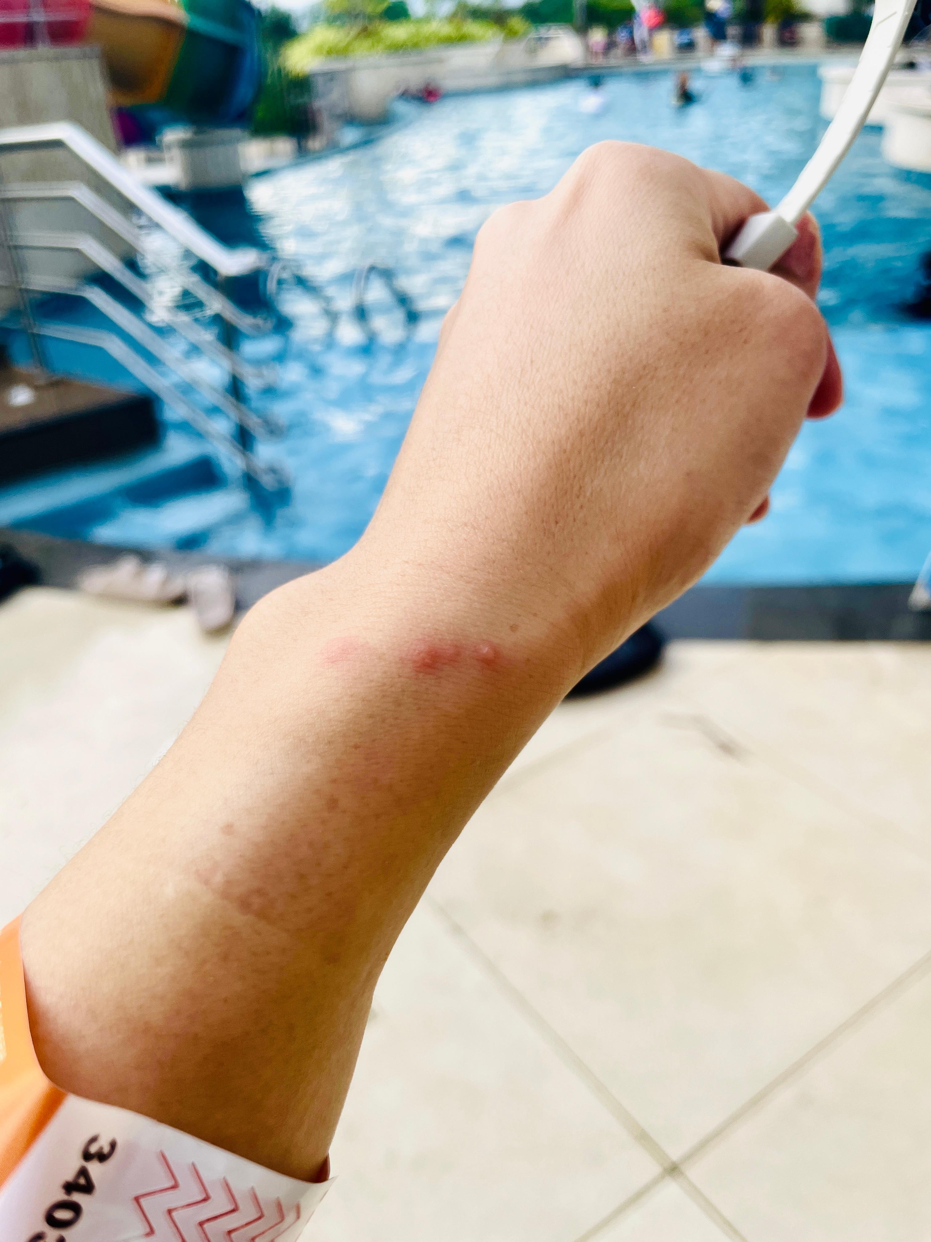 トコジラミ刺され後、宿泊3日