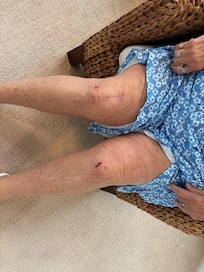 Friend six days after healing from fall