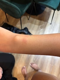 Bed Bug bite on right arm