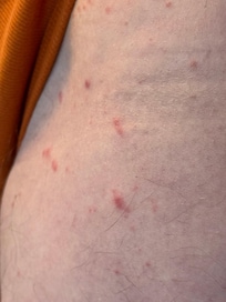 More bites and rash