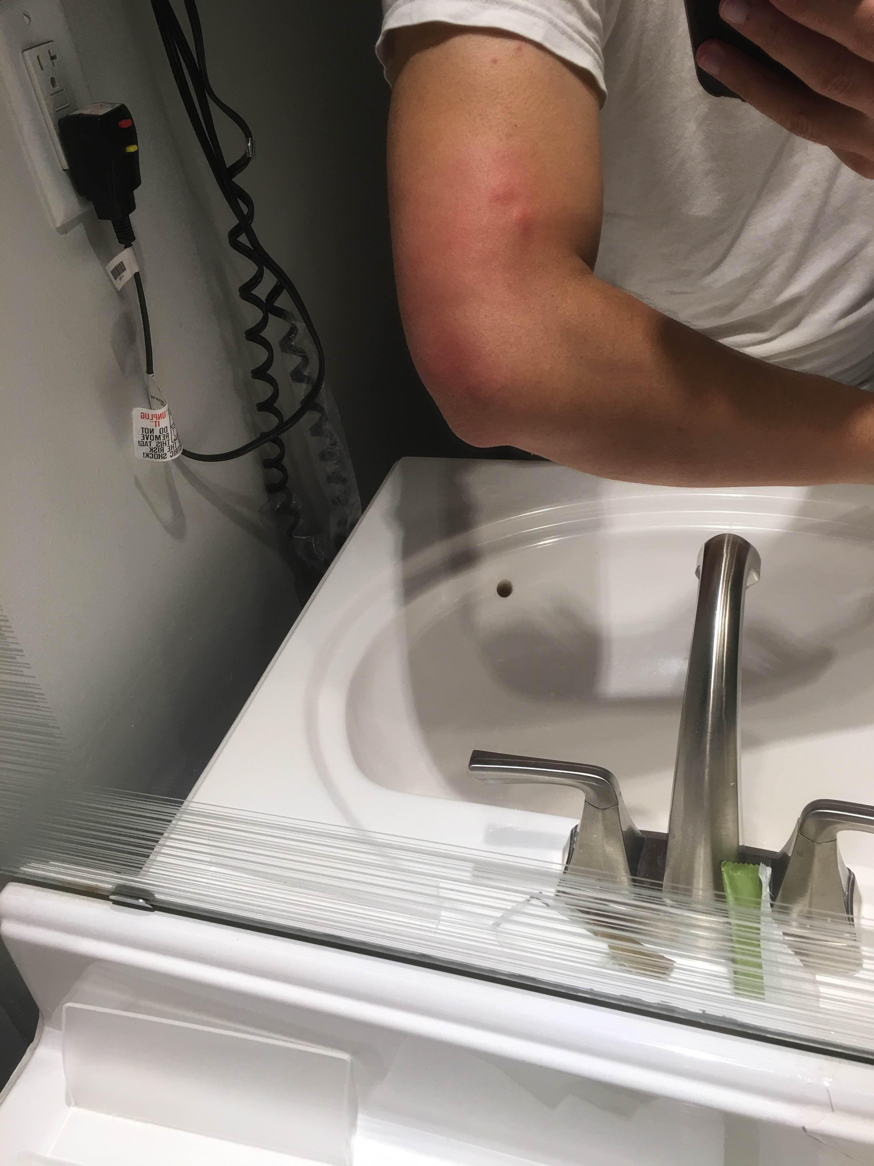 Bed bug bites of left arms