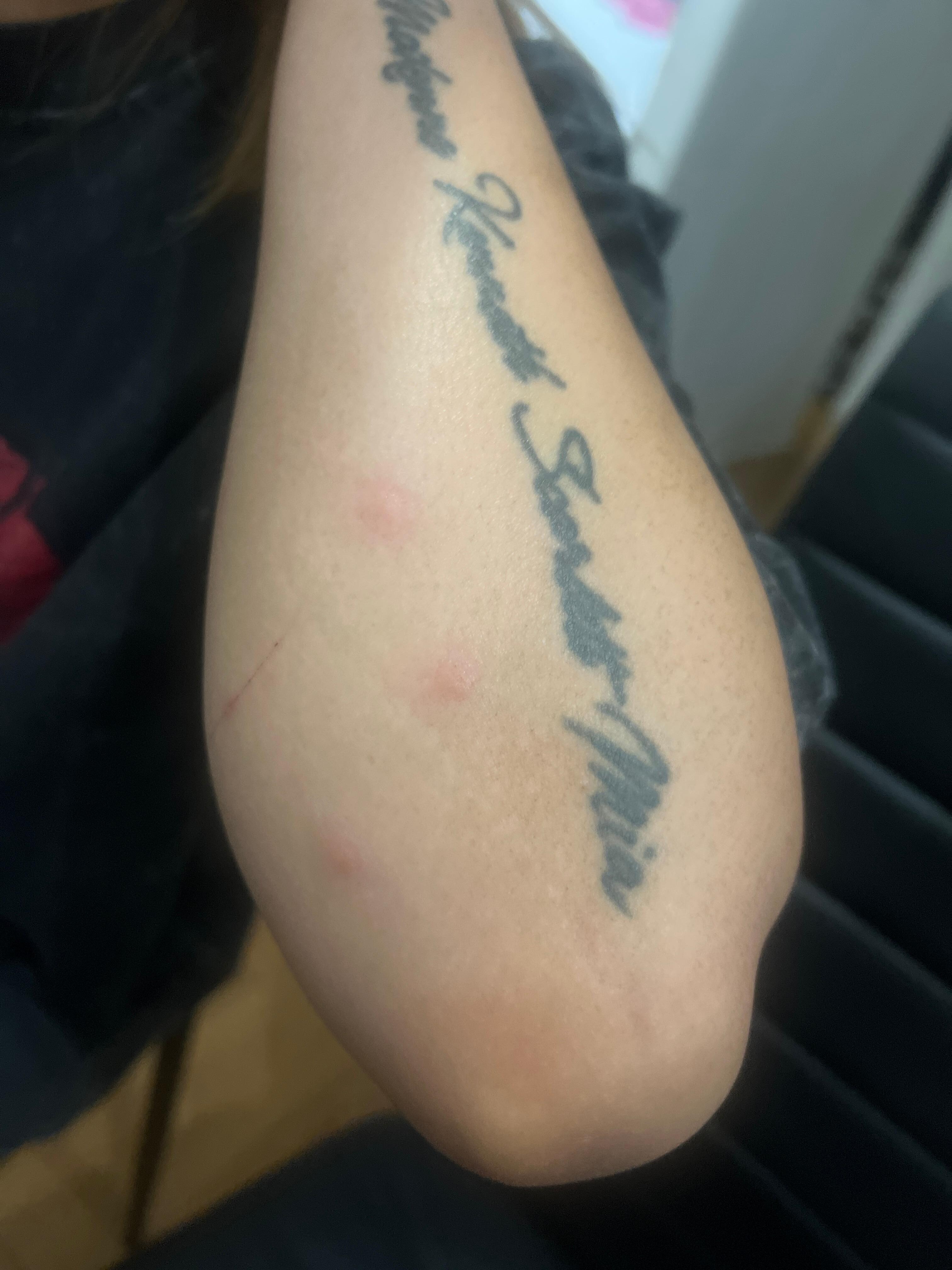 Bedbug bites